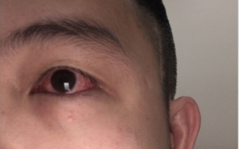 F0 bị đỏ mắt, bác sĩ cảnh báo 'triệu chứng không thể chủ quan'