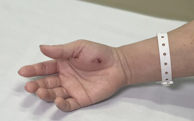 Vết cắn của con cu li trên tay bệnh nhân (Ảnh: baophapluat.vn)