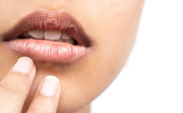 Viền môi bị thâm phải làm sao? Cách trị thâm viền môi hiệu quả