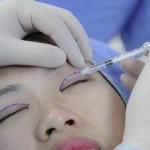 Thiếu nữ 23 tuổi bị mù sau khi đi cắt mí tại một spa ở Hà Nội