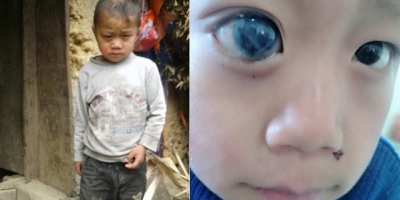 Cậu bé H'Mông đứng trước nguy cơ bị mù mắt vì gia cảnh khó khăn, không có tiền đi khám bệnh