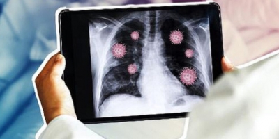 F0 không triệu chứng nhưng phổi vẫn trắng xóa hậu COVID-19 là dấu hiệu của bệnh gì?