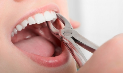 Mùng 1 đi nhổ răng có sao không?