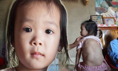 Thương bé gái 4 tuổi oằn mình gánh khối u to như trái bưởi trên lưng