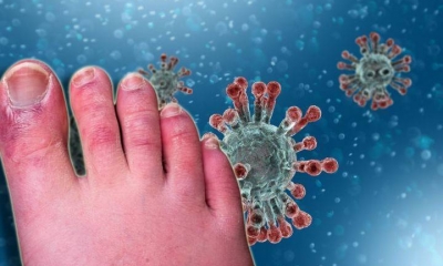 Ngón chân COVID là hiện tượng gì và ngón chân COVID có phải do virus SARS-CoV-2 gây ra không?