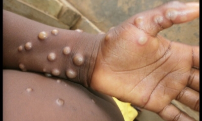 6 biện pháp phòng chống bệnh đậu mùa khỉ được Bộ Y tế khuyến cáo
