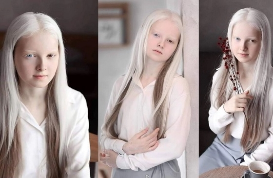 Vẻ đẹp như 'công chúa tuyết' của cô gái Nga bị mắc bệnh bạch tạng khiến người xem sửng sốt