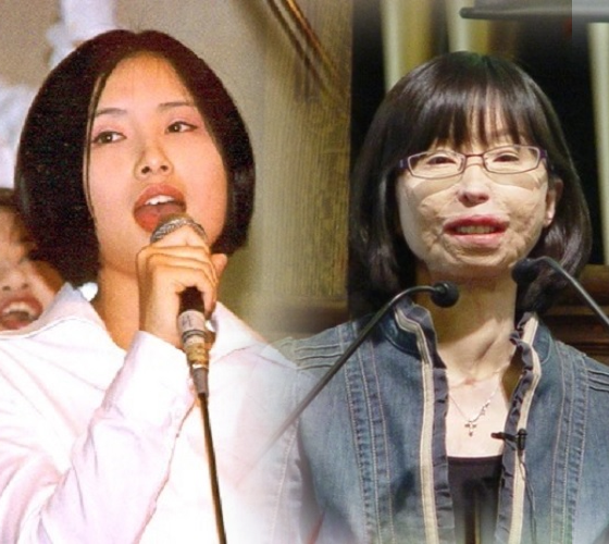 Lee Ji Seon đánh bại nghịch cảnh: Từ cô sinh viên bị tai nạn hủy dung đến nữ giảng viên truyền cảm hứng