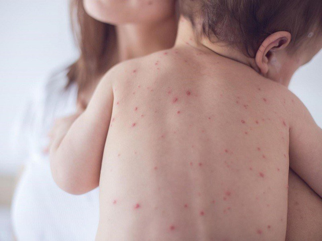 Ở giai đoạn khởi phát, trẻ bắt đầu có dấu hiệu nổi ban đỏ, sốt cao và mệt mỏi (Ảnh: Internet). bệnh thủy đậu