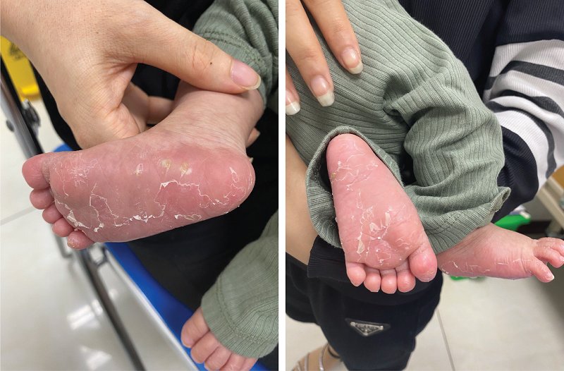 Trẻ bị bong tróc da chân, tay, quấy khóc không rõ nguyên nhân, được đưa đến khám tại BVĐK Medlatec 296361320_225760417438992