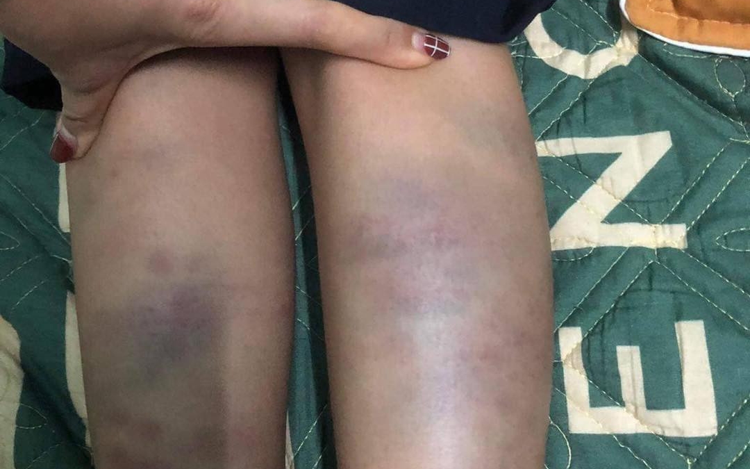 Học sinh lớp 1 ở Đà Nẵng bị bạn đánh bầm tím tay chân
