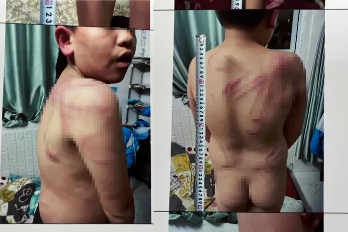 Lâm Đồng: Tạm giữ người cha bạo hành con trai ruột 10 tuổi