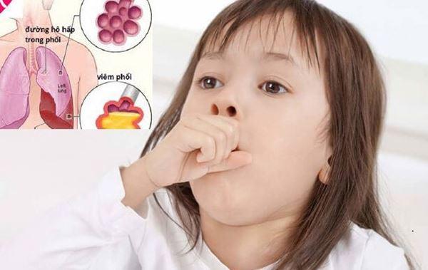 Viêm phổi ở trẻ em: Nguyên nhân, dấu hiệu, chẩn đoán bệnh
